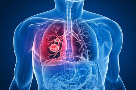 Pneumonia