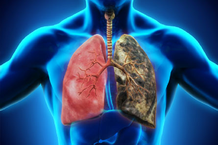 COPD