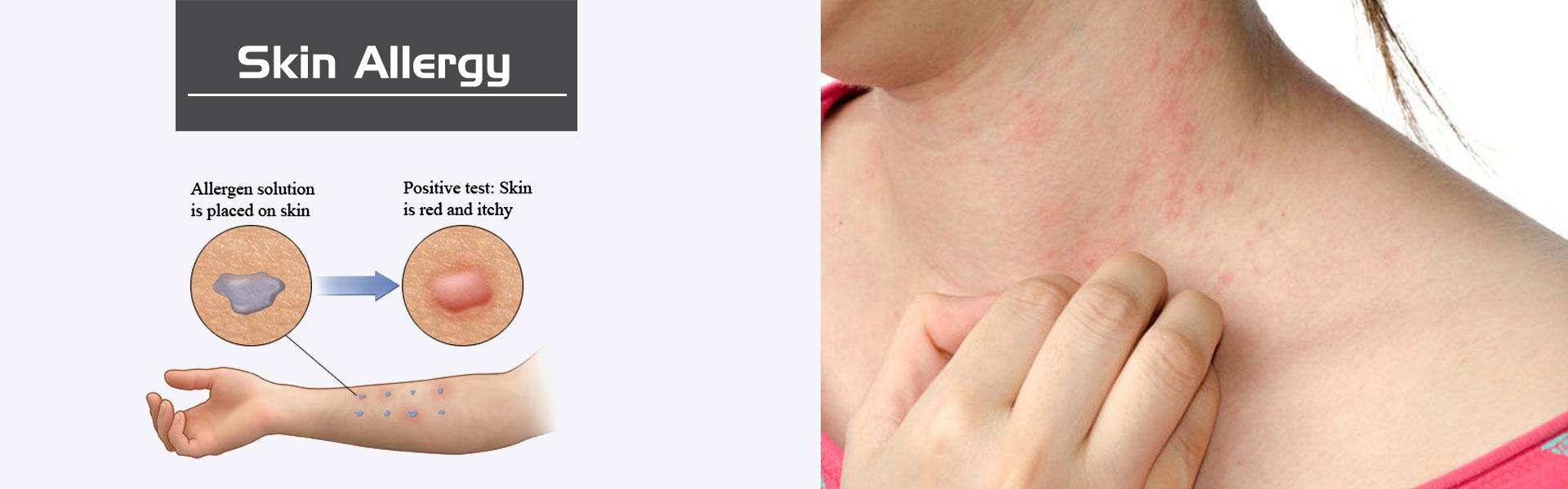 Skin Allergy