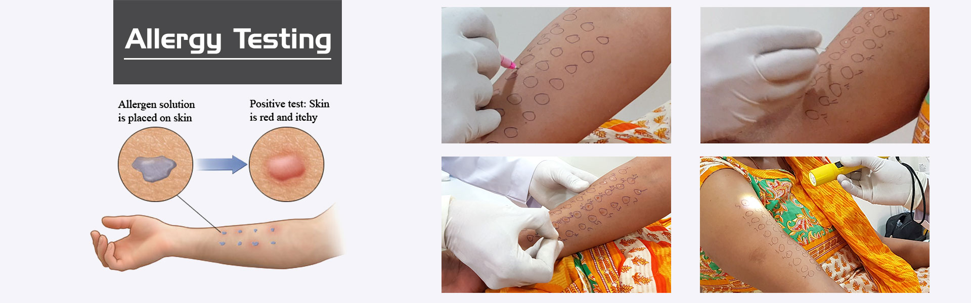 Skin Allergy